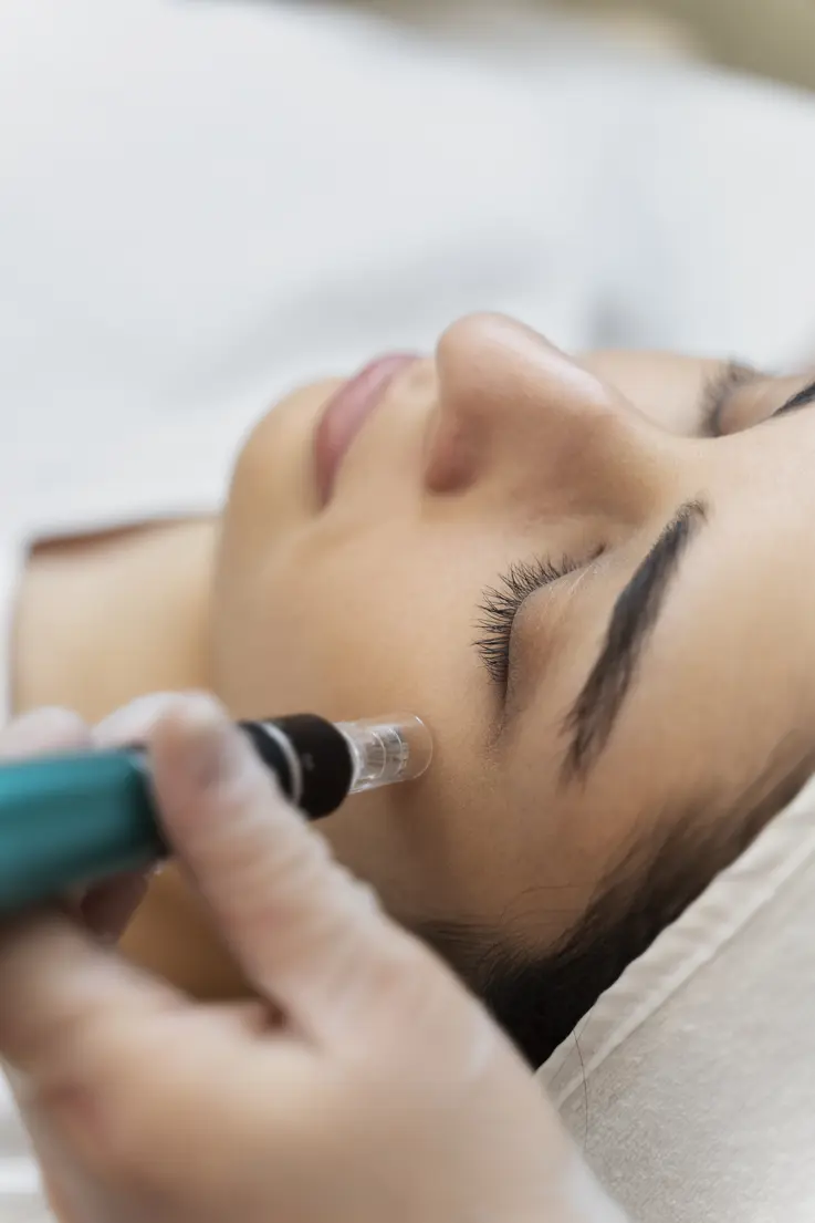 Dermapen / Dermaroller Tedavisi Dermapen ile yüze microneedling uygulaması